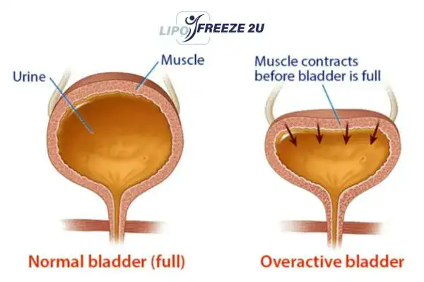 diagram of overactive bladder treatment Livingston