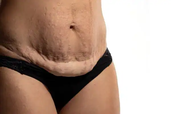 loose skin after weight loss injections Livingston