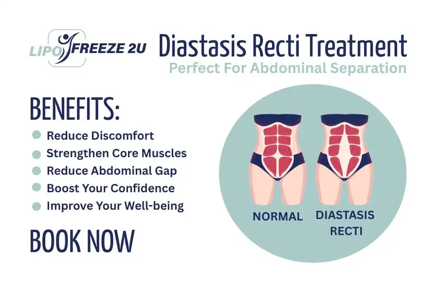 How Long Will It Take to See Improvements in Diastasis Recti Livingston