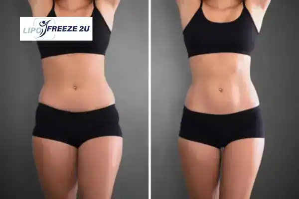 How Can LIPO FREEZE 2U Support Your Post-Pregnancy Body Recovery Livingston?